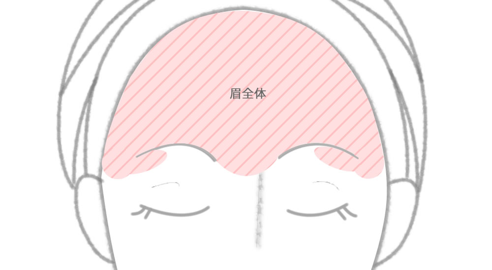眉毛周り全体の脱毛範囲を示したイラスト画像