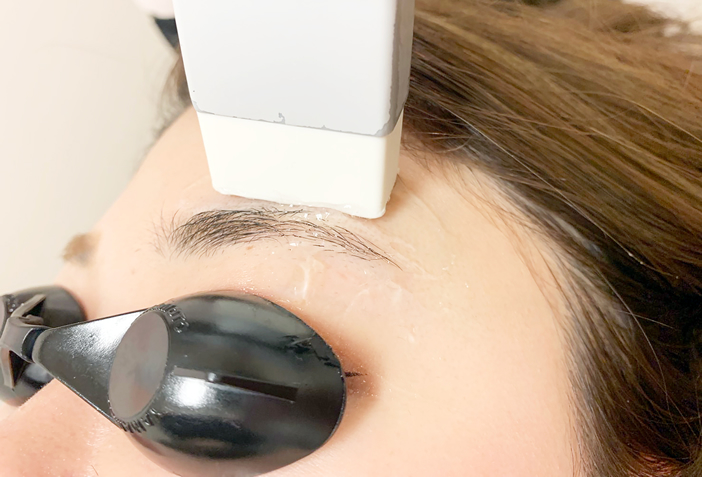 眉毛の上部に脱毛照射をしている様子の写真