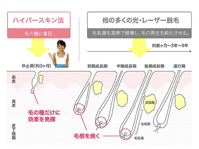 従来の脱毛と高熱処理不要なハイパースキン脱毛の比較図